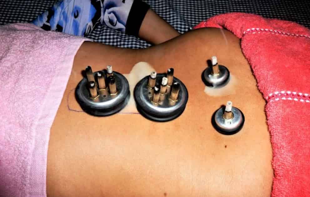 Moxibustion therapy treatment
